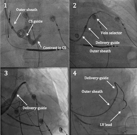 Left Ventricular Lead Placement for Cardiac Resynchronization 